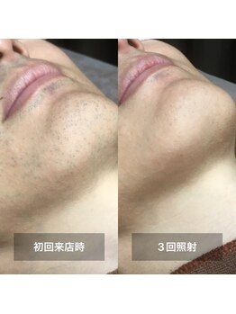 リムル(REMURU)/ひげ脱毛3回照射