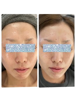 ブルームーン(Blue Moon)/REVI 1回施術