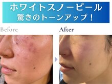 シエル/スノーホワイトピール白雪肌