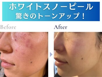 シエル/スノーホワイトピール白雪肌