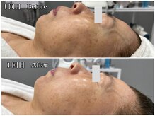 エミマス ボーテ(Emimas Beaute’)/６０代　毛穴洗浄＆幹細胞