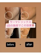 パンパラソル(Pin Parasol)/引上げには”サーマトリックス”