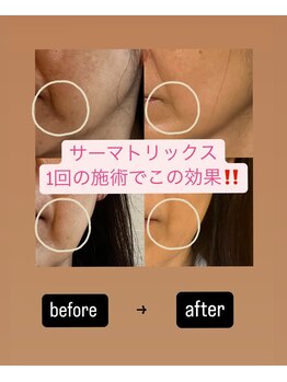 パンパラソル(Pin Parasol)/引上げには”サーマトリックス”