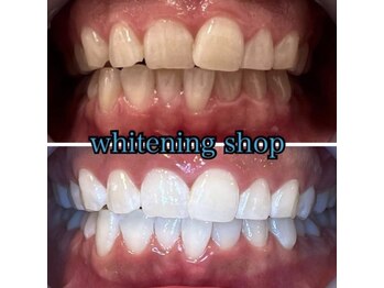ホワイトニングショップ 三田店/before after