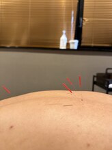 アディクト(Addict)/身体にも鍼打てます☆