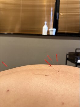 アディクト(Addict)/身体にも鍼打てます☆