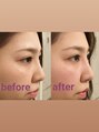 隆鼻矯正専門店 ラプリ(Raplit) 隆鼻+輪郭矯正40分10回#美鼻#小顔#小顔矯正