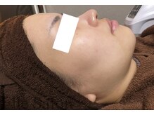 エル(Elle)/2回目after