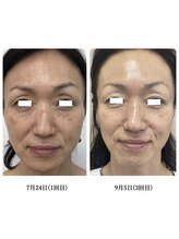 エミット(emit.)/幹細胞エクソソーム導入