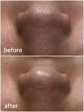 モテ 新宿店(Mote)/ハイドラ毛穴洗浄＋艶肌Wax 新宿