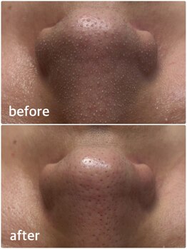 モテ 新宿店(Mote)/ハイドラ毛穴洗浄＋艶肌Wax 新宿