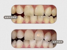 繰り返し行う事で理想の白さに！白くなるから通うのも楽しい♪