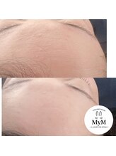 マイム(MyM)/施術例