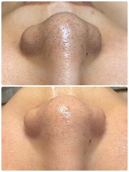 リンク(LINK.)/Face Wax Treatment