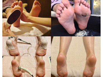 カカトのケアは角質育成ケア人気