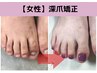 【再発させない深爪矯正】女性フット