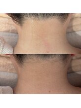 アンク(ankh.)/施術例