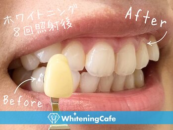 ホワイトニングカフェ 仙台店(WhiteningCafe)/☆歯のホワイトニング施術写真☆