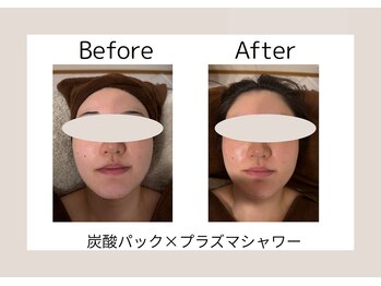 美成(vise)/ビフォーアフター