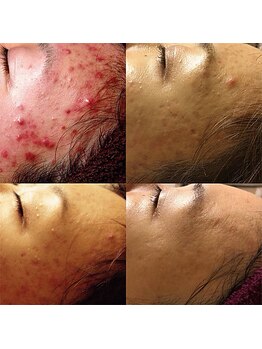 ミルジュ(MiLuJu)の写真/【美白/くすみ改善/透明感タラソトリートメント90分¥16500】お肌に休息を♪紫外線、乾燥で荒れた肌改善に◎