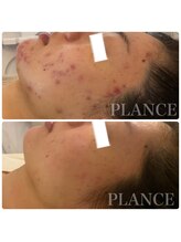 プランス 福岡(PLANCE)/ニキビケア福岡天神