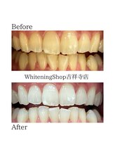 ホワイトニングショップ 吉祥寺店/【ビフォーアフター】