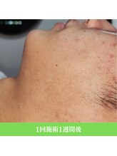 レイ(R.E.I)/【アフター】程度：低