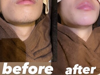 ソーレエルーナ(SOLE e LUNA)/ヒゲ光脱毛 お試し メンズ