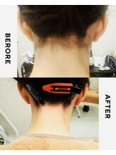 ユメバンチ(yumebanchi)/うなじW脱毛