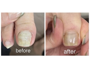 カラーホリック ネイルスパ(Colorholic Nailspa)/巻き爪補正