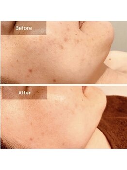 エミルカ 千葉店(EMILUCA)/ハーブピーリング顔/シミケア