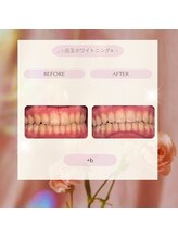 プラスビー 2号店(+b)/ホワイトニングビフォーアフター