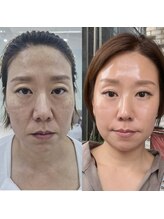 ココ(COCO)/口横たるみ/頬こけ/リフトアップ