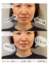 サロンマニア(SALON MANIA)/6回/ほうれい線たるみの効果