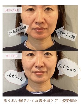 サロンマニア(SALON MANIA)/6回/ほうれい線たるみの効果