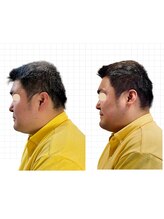 東麻布アマン(東麻布Aman)/美容鍼は男性にもオススメ