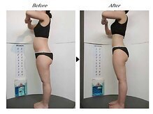 ビューティークリニックコダマ 日向店/【1か月コース】Y.H様（27歳）