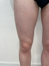 ロイビー(loeyB)/脱毛１目回から1ヶ月後