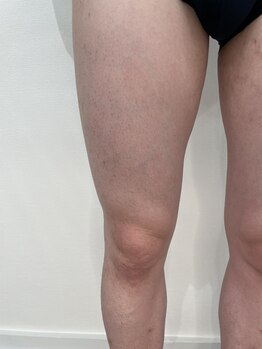 ロイビー(loeyB)/脱毛1目回から1ヶ月後