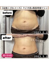 アンリミット(Unlimit)/産後の自分のお腹で実験！