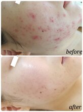 アイビー(IVY.L)/ハーブピーリング