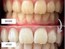 リンネ(Rin'ne)/[ホワイトニング] 15分×2回照射