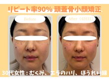 ウル 下北沢(Ulu)の雰囲気（リピート率90%！自信が持てるフェイスラインに♪#小顔#下北沢）