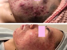 秋の荒れ肌もお任せ◎【久留米/脱毛/痩身/毛穴/肌質改善】