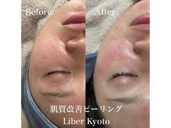 リベルキョウト 京都駅前店(Liber Kyoto)/肌質改善ピーリング