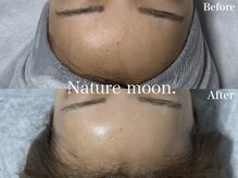 ナチュールムーン(Nature moon.)/ハーブピーリング