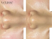 Velisse 表参道店【ヴェリス】《毛穴/肌質改善/ハーブピーリング/ニキビケア》/
