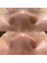ビーグロウ(be Grow)/毛穴洗浄＋ハーブピーリング