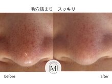 ミヨン(Miyong)/つるん鼻♪毛穴のポツポツ改善◎