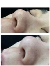 エステティックサロン ルテラ/毛穴ピッカピカ